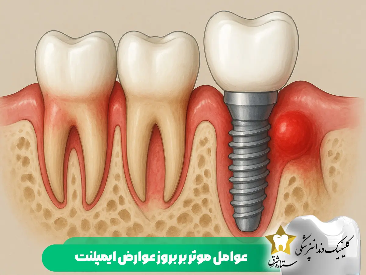 عوامل مؤثر بر بروز عوارض ایمپلنت