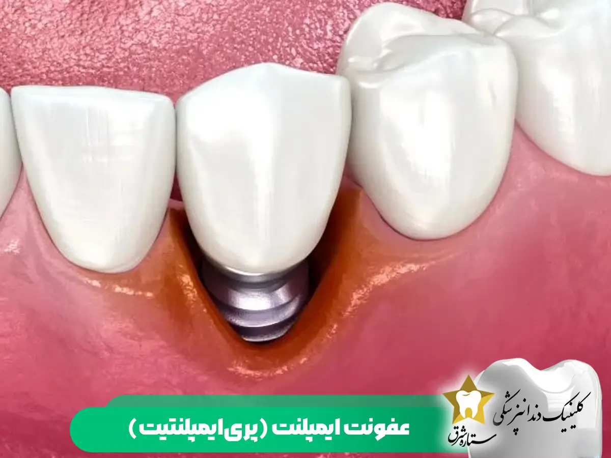 عفونت ایمپلنت