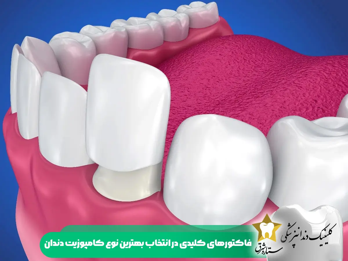 فاکتورهای کلیدی در انتخاب بهترین نوع کامپوزیت دندان