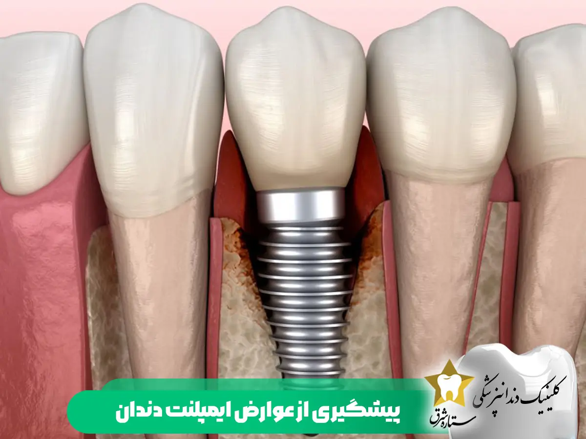 پیشگیری از عوارض ایمپلنت دندان