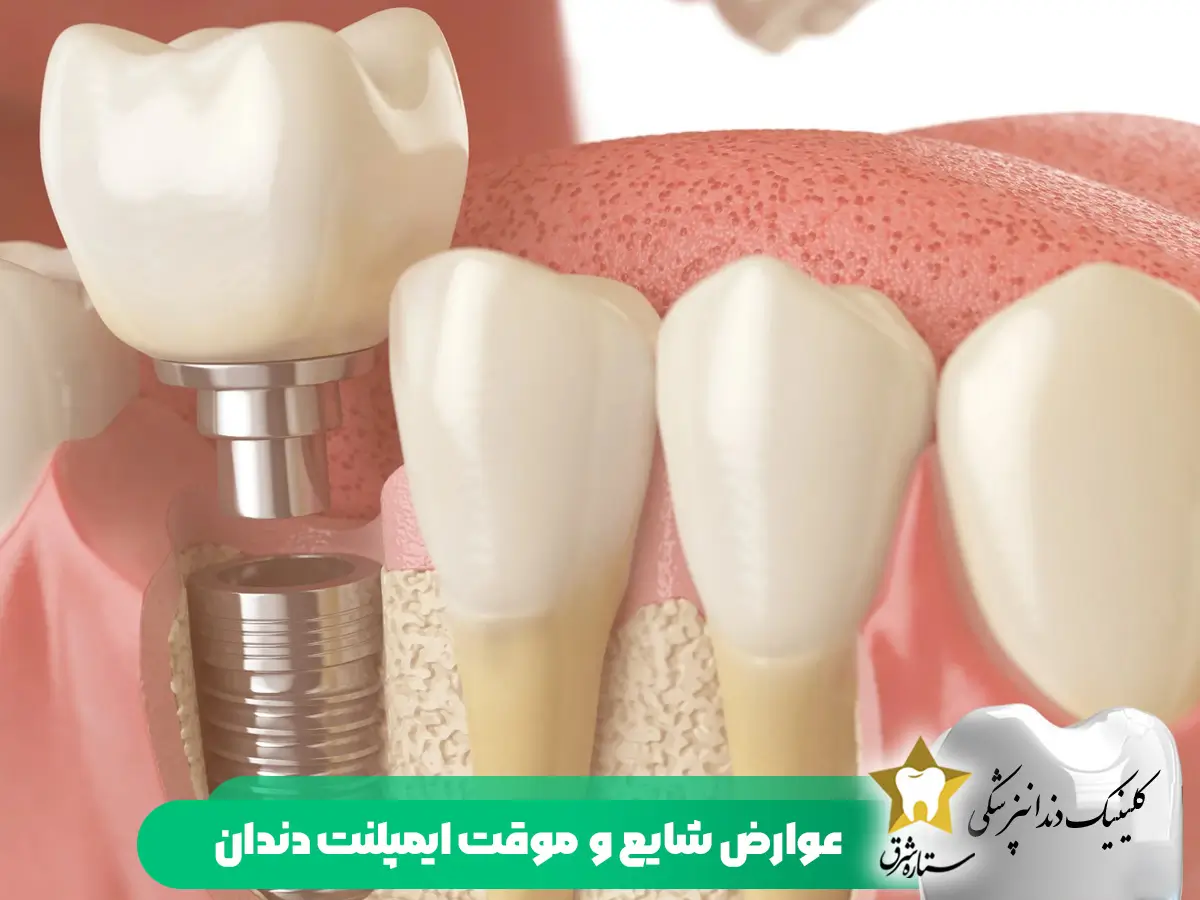 عوارض شایع و موقت ایمپلنت دندان