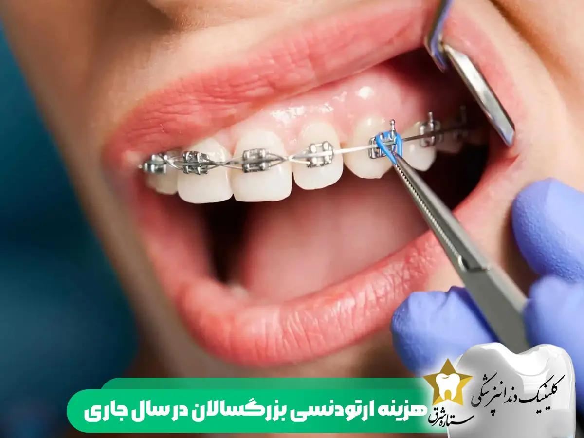 هزینه ارتودنسی بزرگسالان در سال جاری