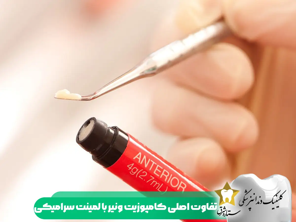 تفاوت اصلی کامپوزیت ونیر با لمینت سرامیکی