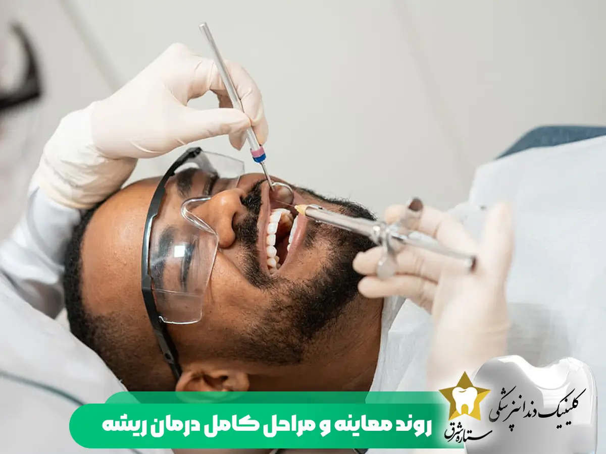 روند معاینه و مراحل کامل درمان ریشه