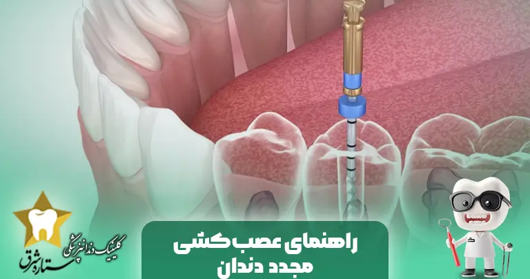 راهنمای کامل عصب کشی مجدد دندان (ری-اندو)
