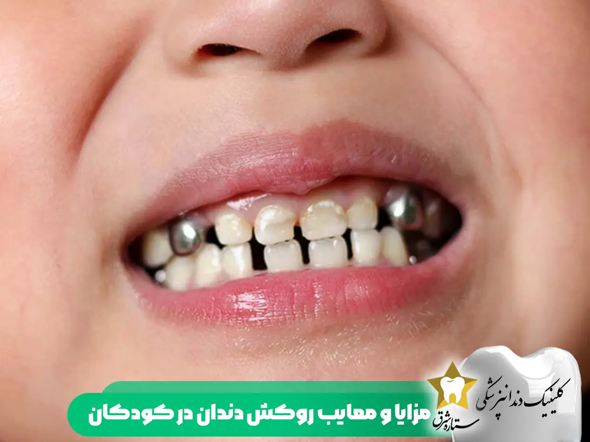 مزایا و معایب روکش دندان در کودکان