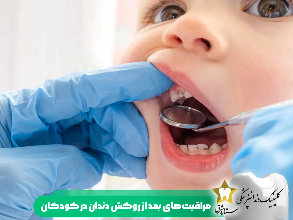 مراقبت های بعد از روکش دندان در کودکان