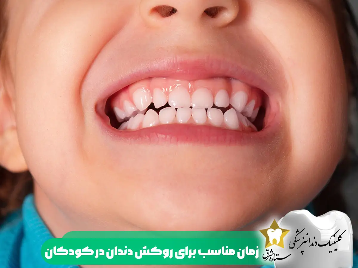 زمان مناسب برای روکش دندان در کودکان