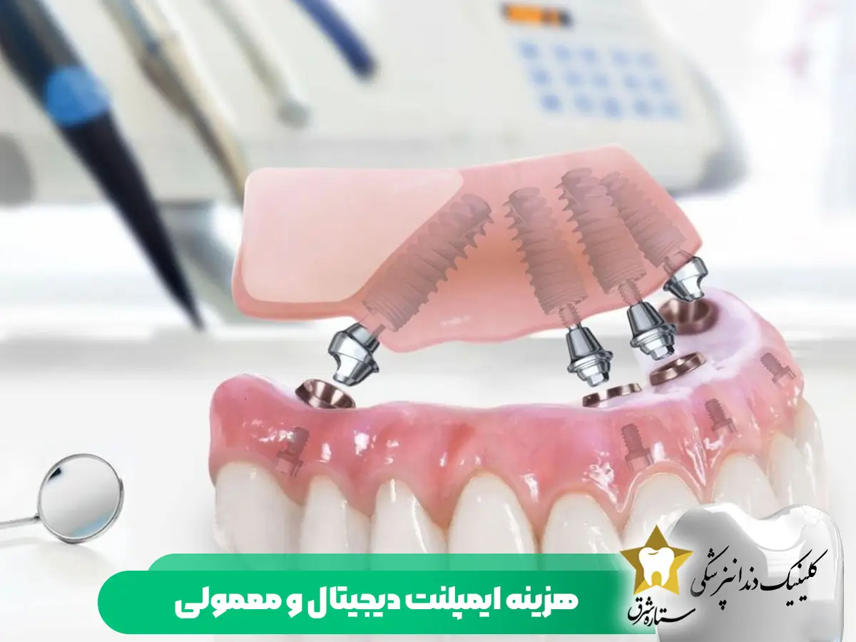 هزینه ایمپلنت دیجیتال و معمولی