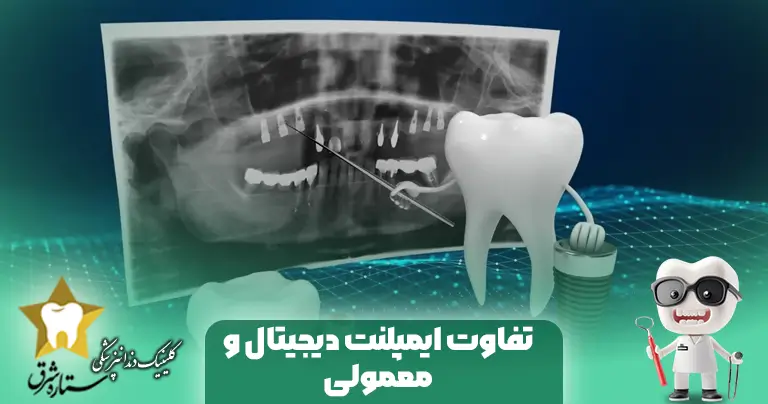 ۹ تفاوت ایمپلنت دیجیتال و معمولی؛ کدام بهتر است؟
