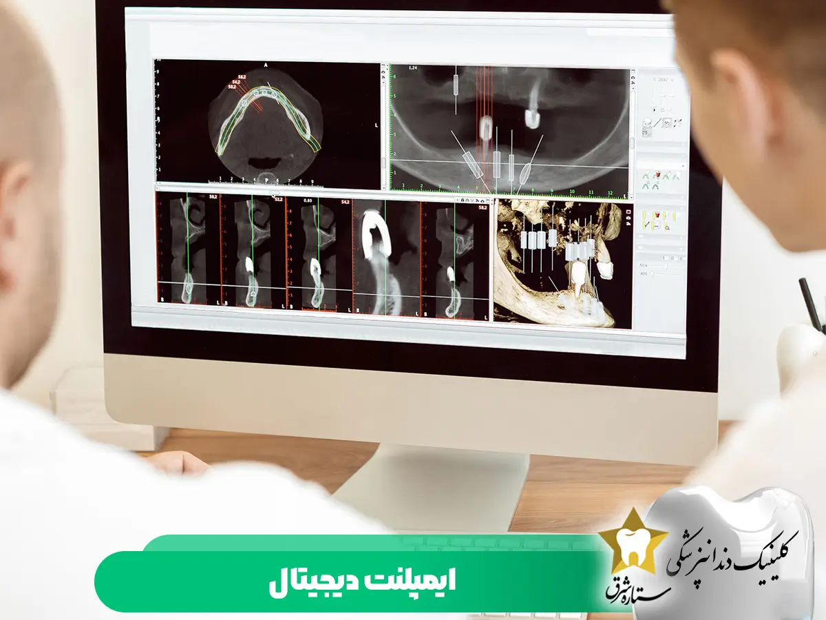 ایمپلنت دیجیتال