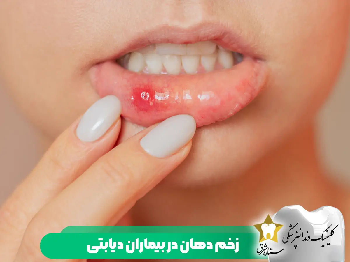 زخم دهان در بیماران دیابتی
