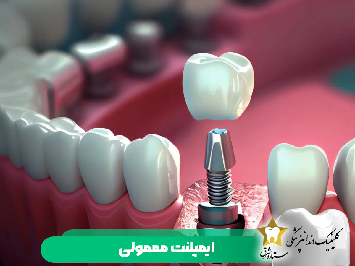 ایمپلنت معمولی