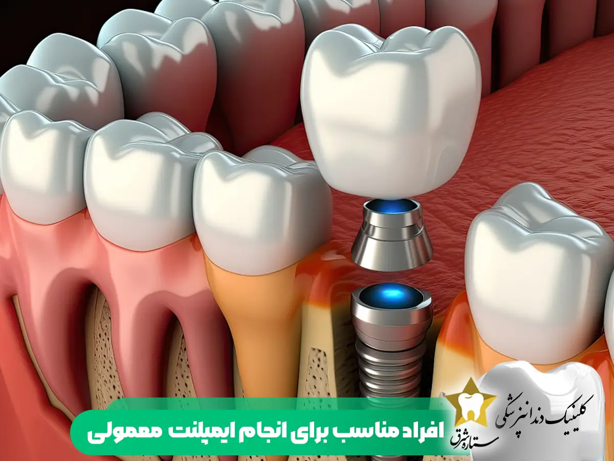 افراد مناسب برای انجام ایمپلنت معمولی