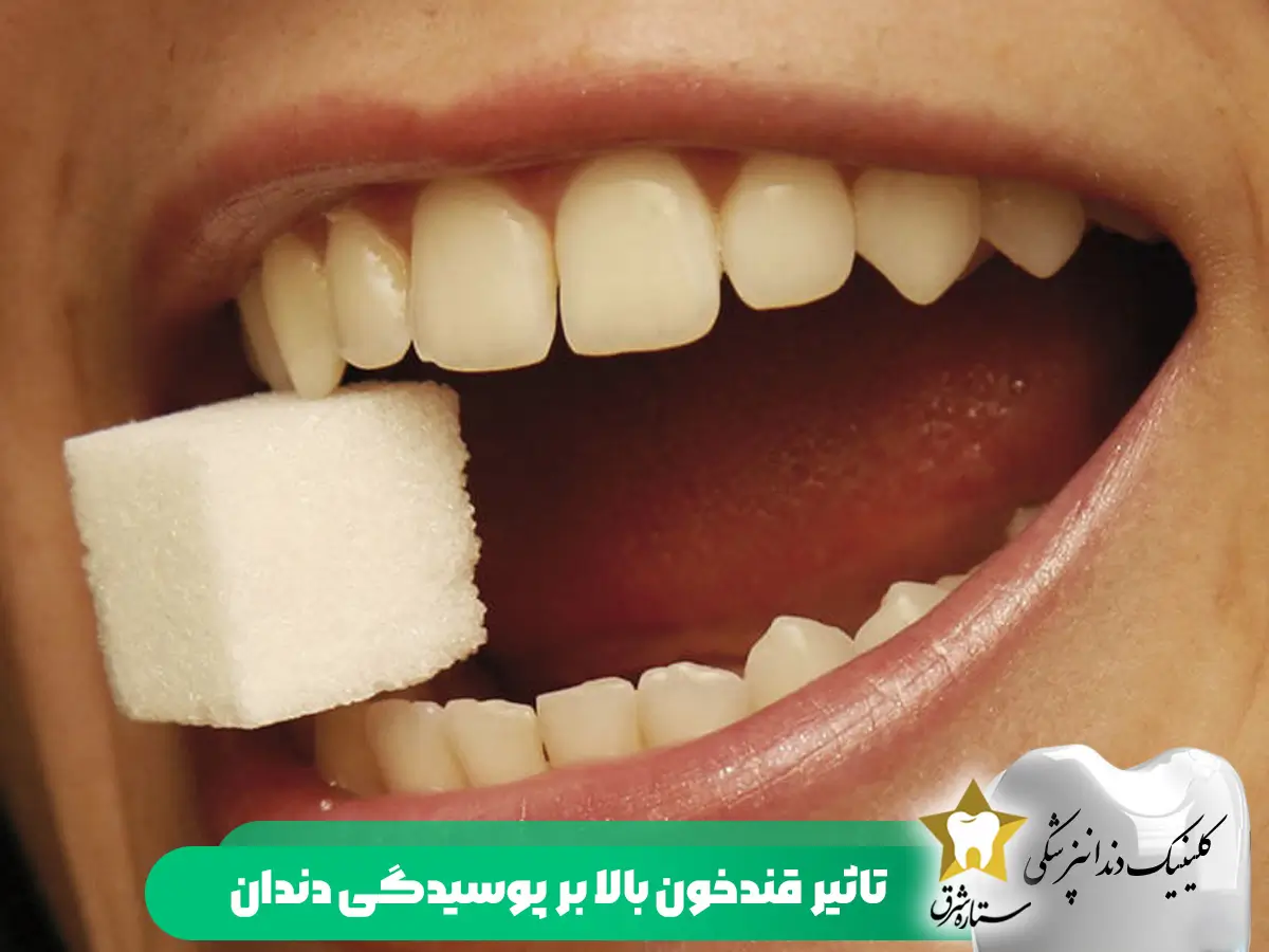 تاثیر قندخون بالا بر پوسیدگی دندان 