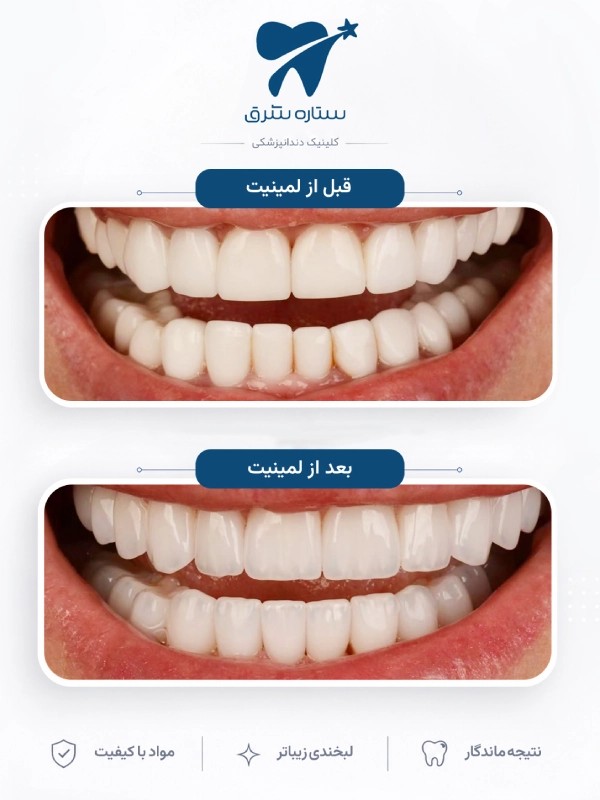 لمینیت دندان