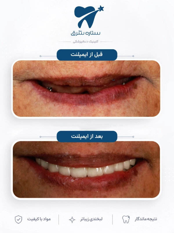 نمونه کار ارتودنسی ستاره شرق ۱