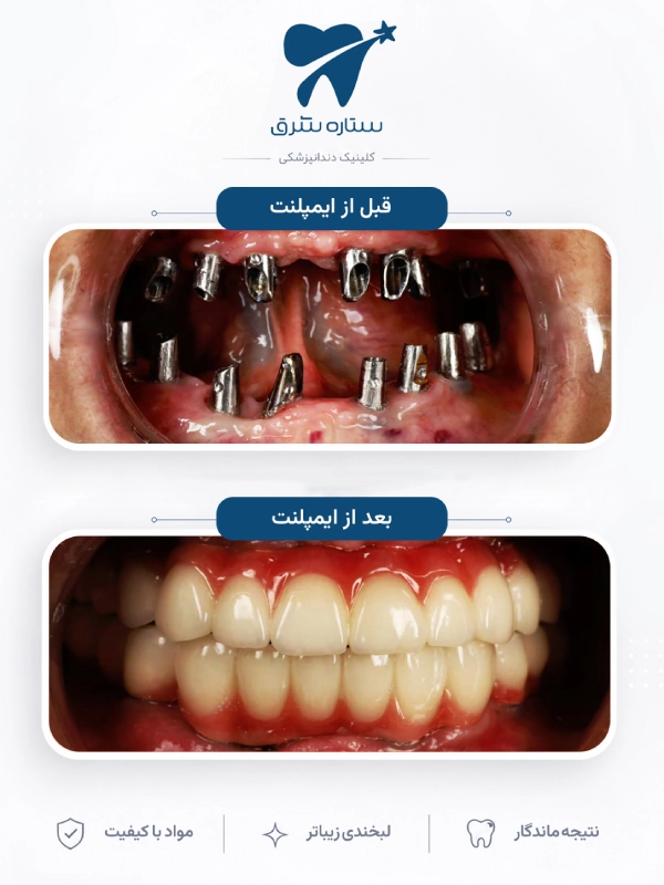 نمونه کار ارتودنسی ستاره شرق ۲