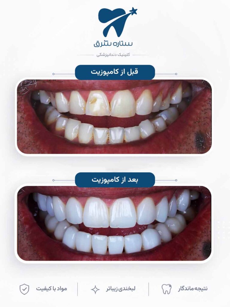 کامپوزیت دندان