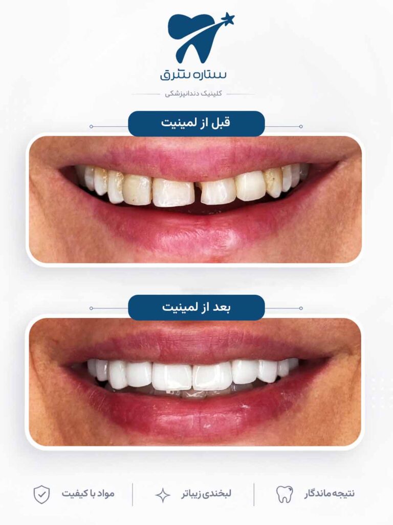 لمینیت دندان