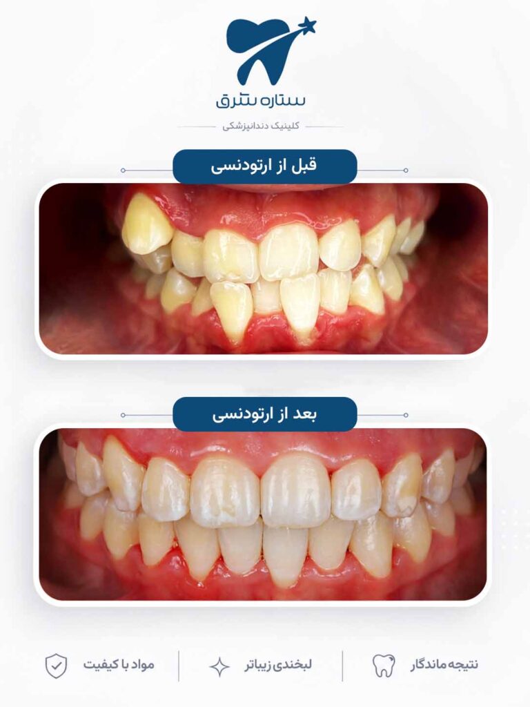 ارتودنسی دندان
