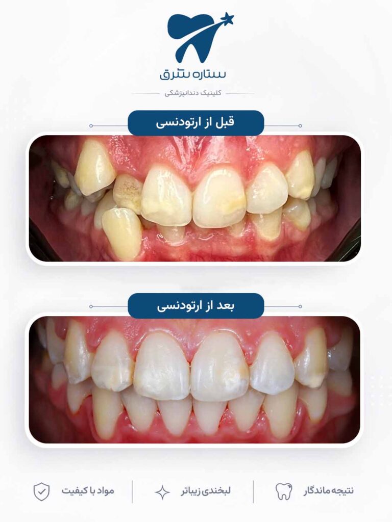 ارتودنسی دندان