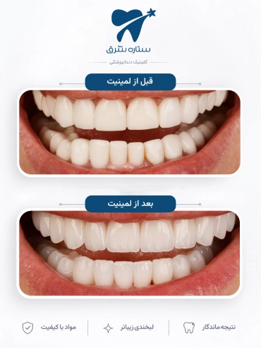 لمینیت دندان