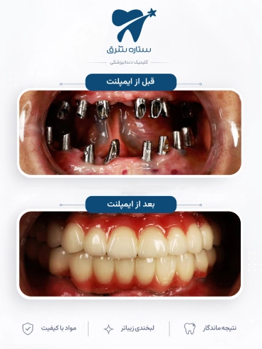 ایمپلنت دندان