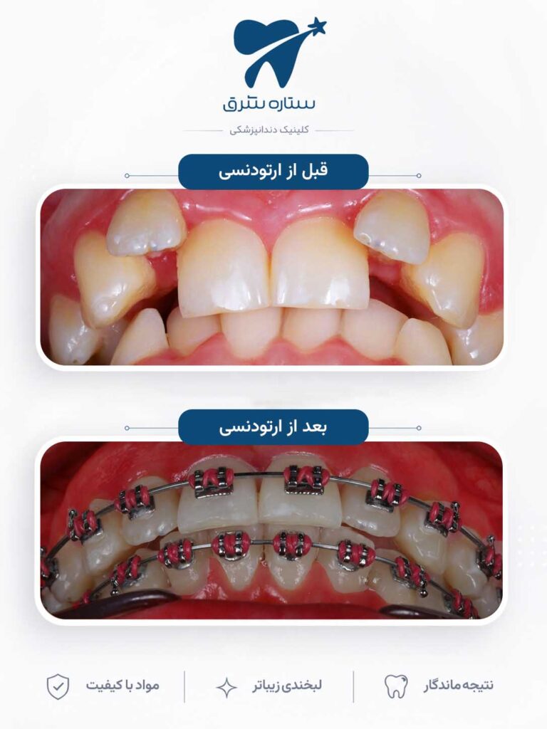 ارتودنسی دندان