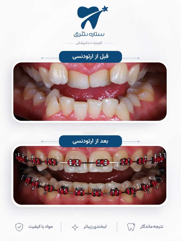 ارتودنسی دندان