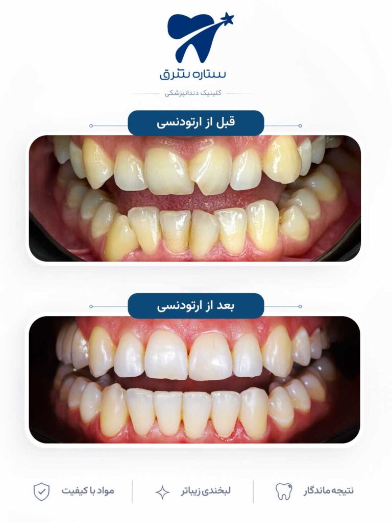 ارتودنسی دندان