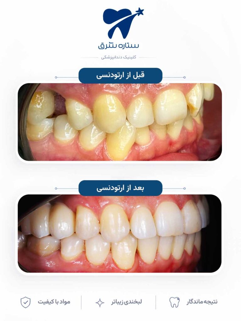 ارتودنسی دندان