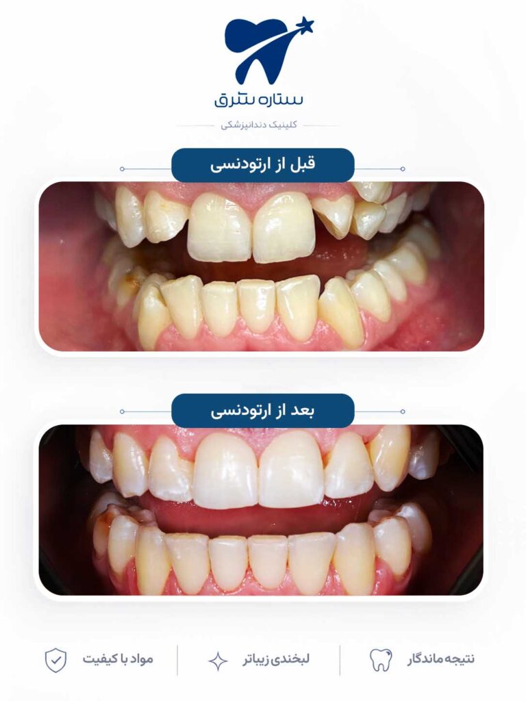 ارتودنسی دندان