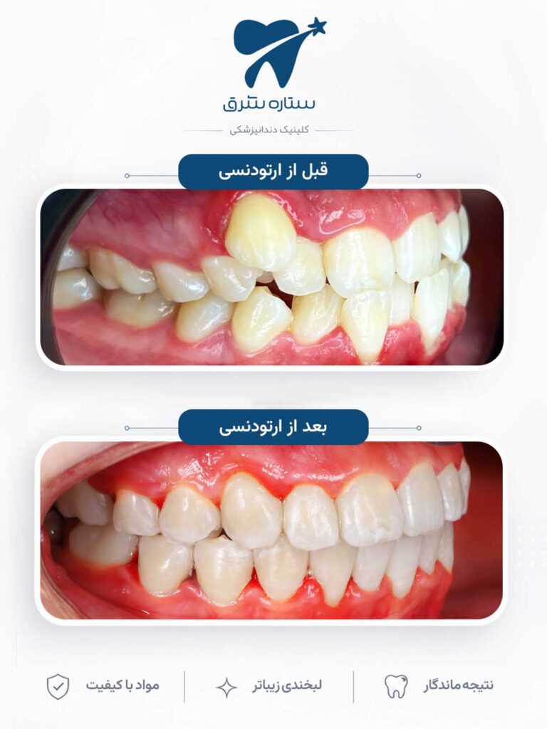 ارتودنسی دندان