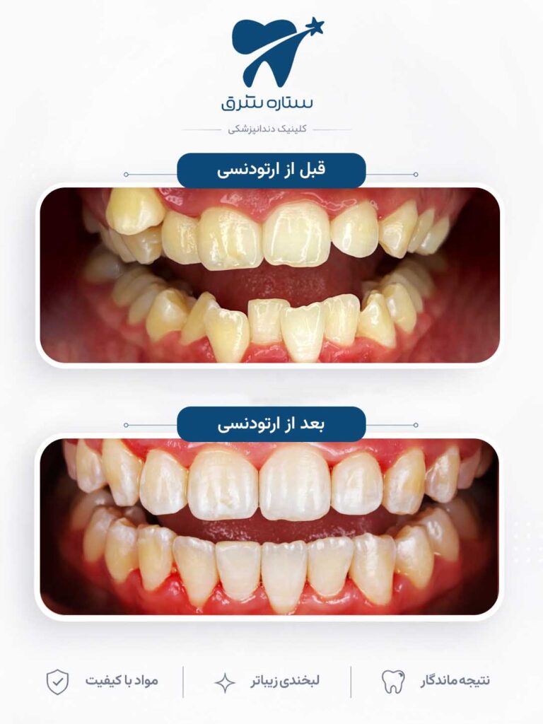 ارتودنسی دندان