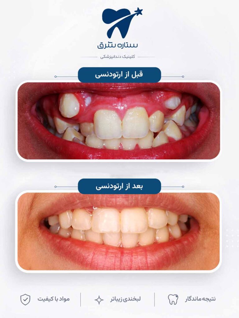 ارتودنسی دندان