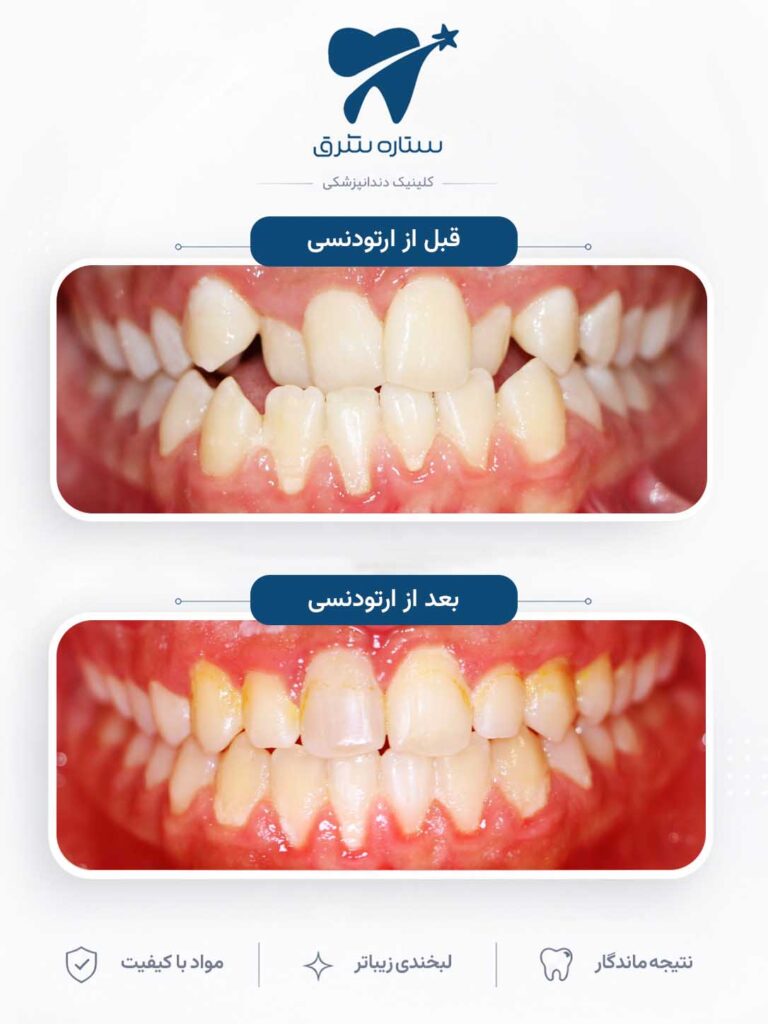 ارتودنسی دندان