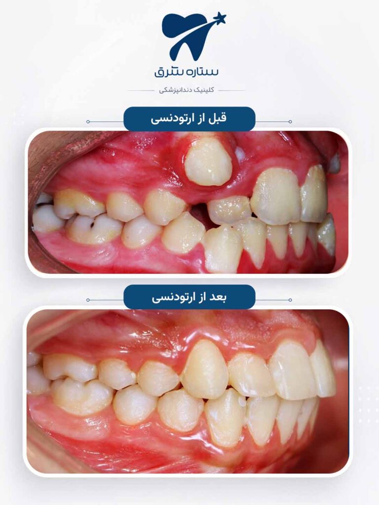 ارتودنسی دندان