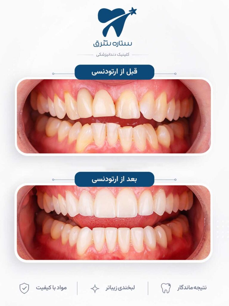 ارتودنسی دندان