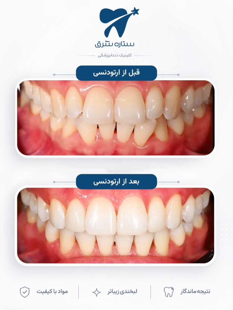 ارتودنسی دندان