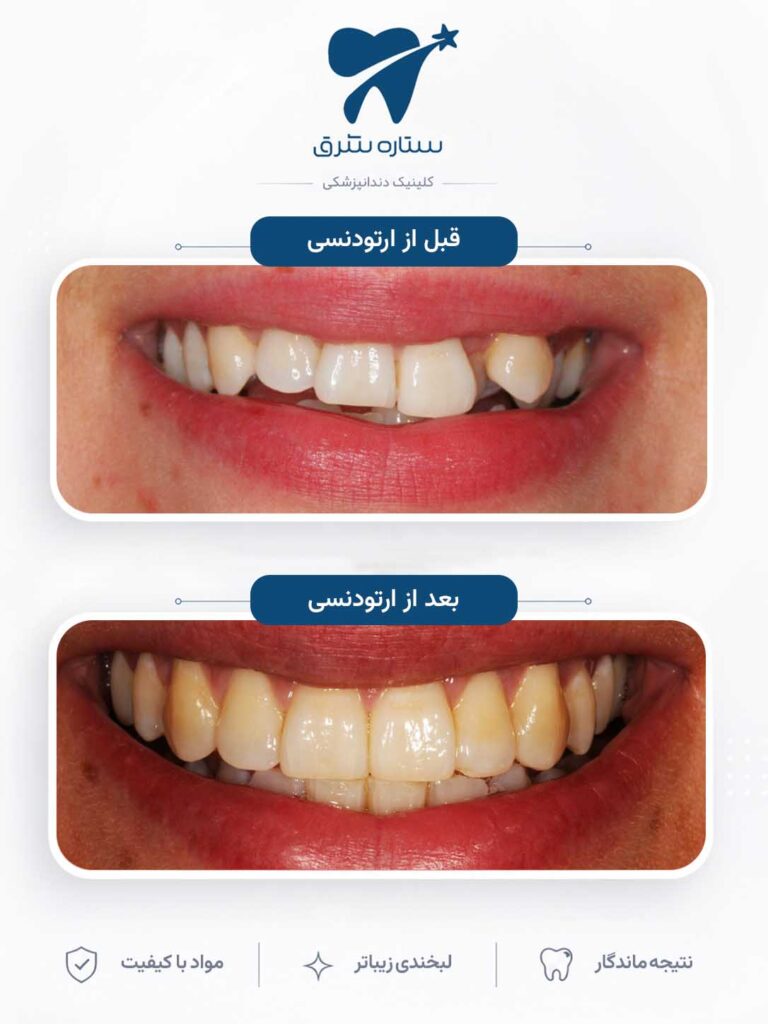 ارتودنسی دندان