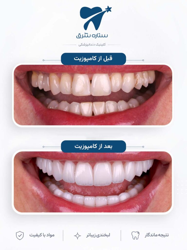 کامپوزیت دندان