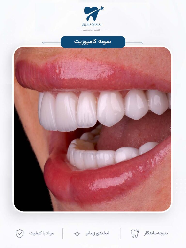 کامپوزیت دندان