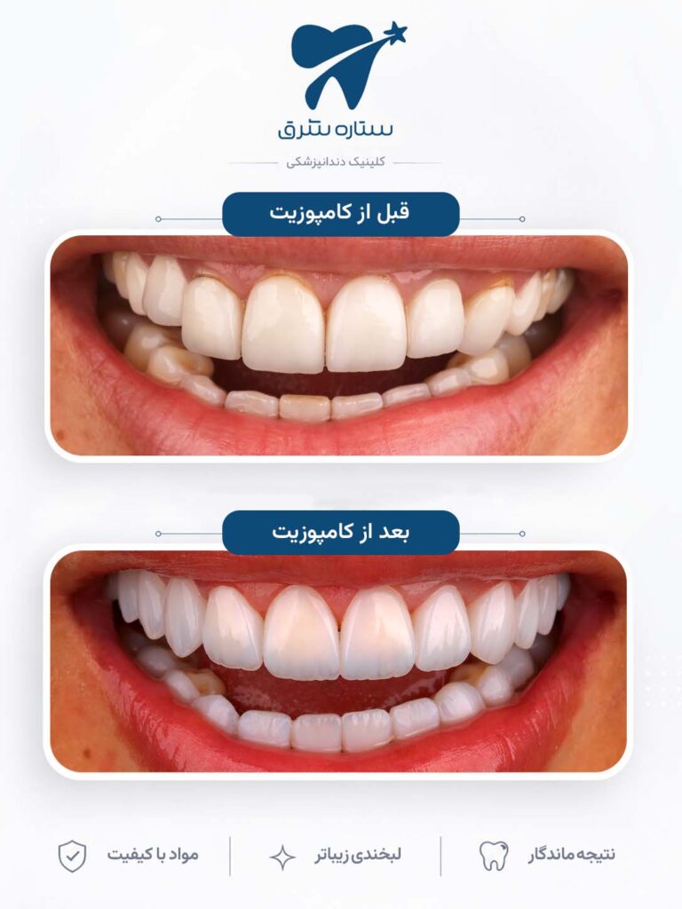 کامپوزیت دندان