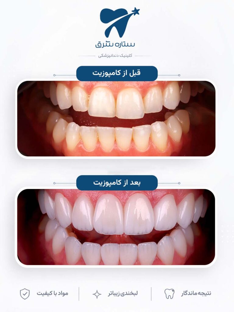 کامپوزیت دندان