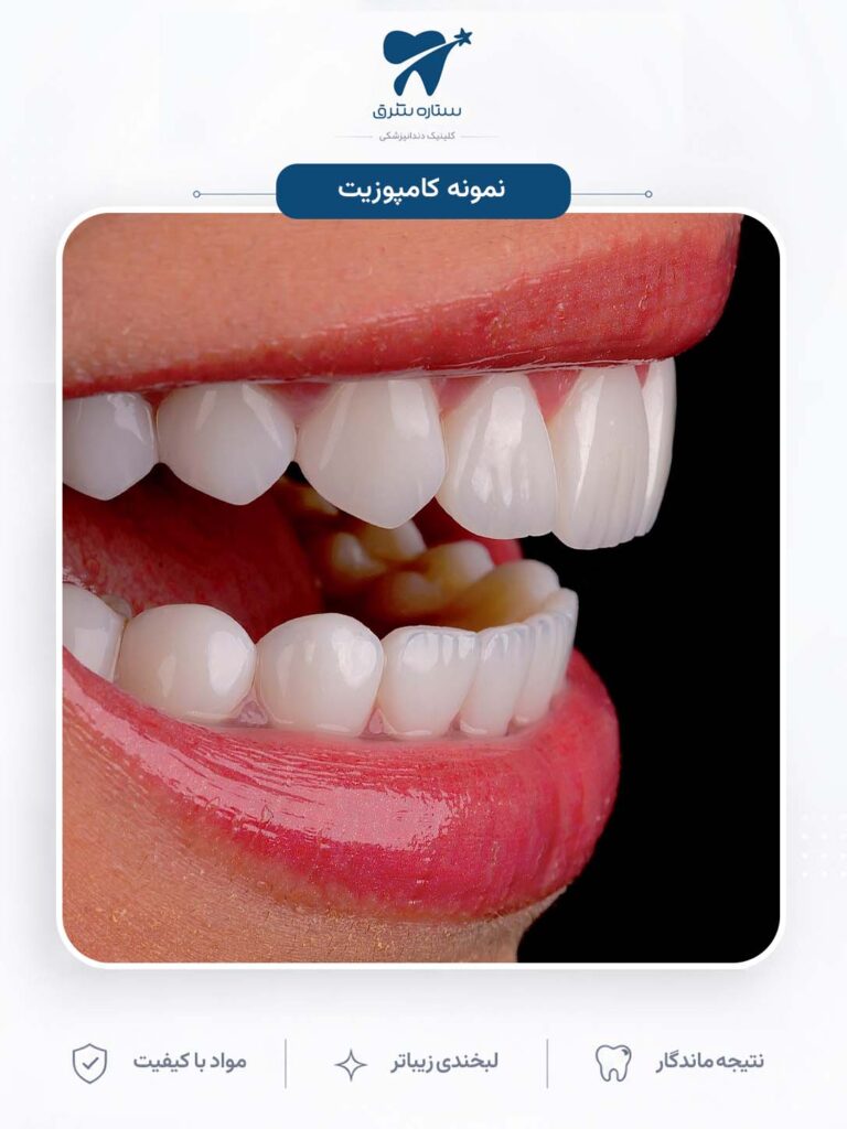 کامپوزیت دندان