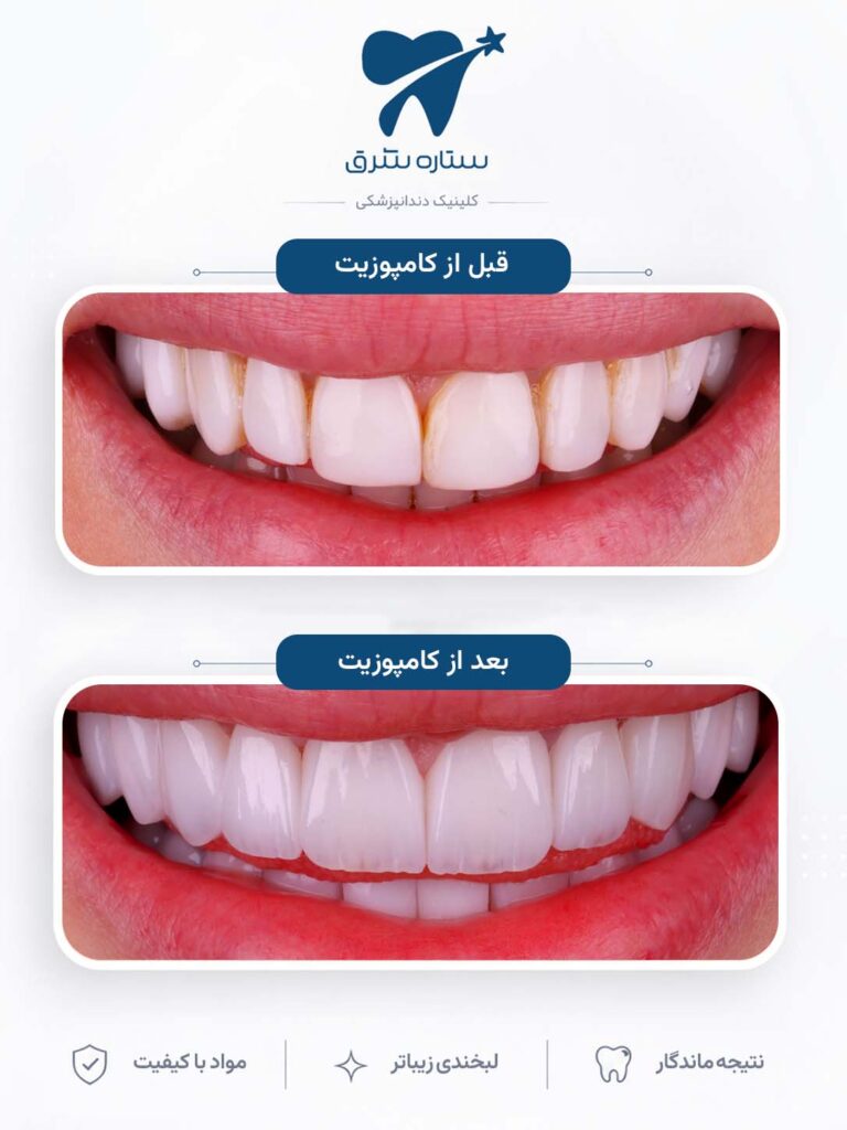 کامپوزیت دندان