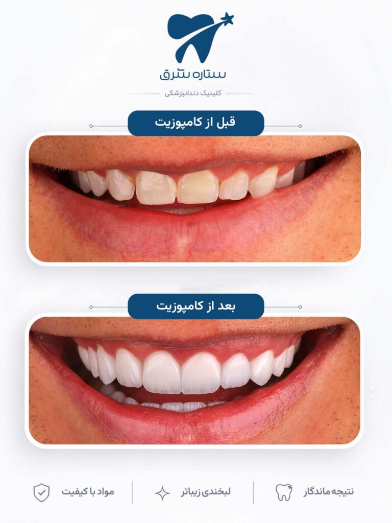 کامپوزیت دندان