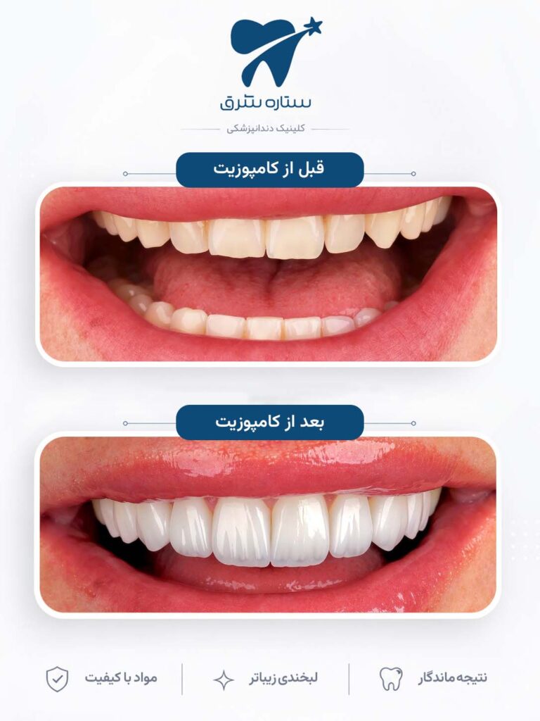 کامپوزیت دندان