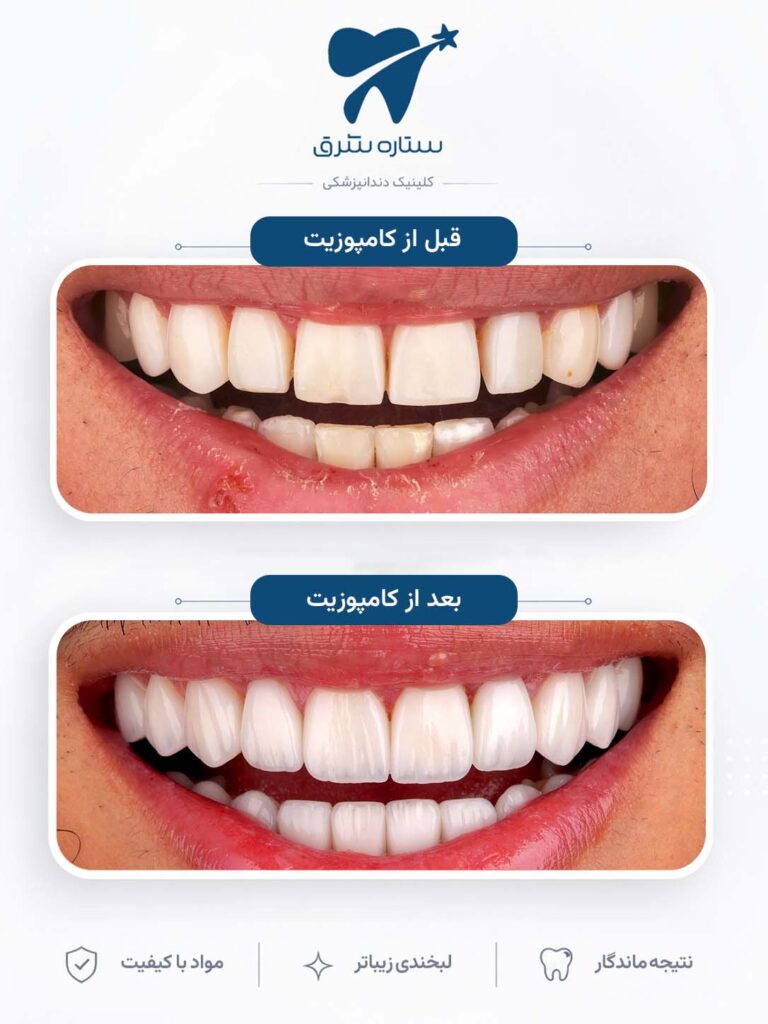 کامپوزیت دندان
